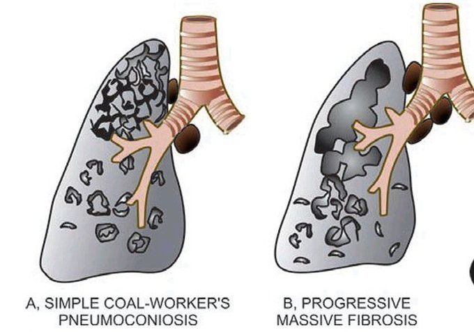 Coal-workers’ pneumoconiosis vs Progressive massive fibrosis