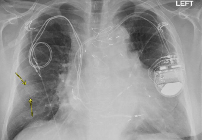 Chest X-ray from a patient included in the study. Posteroanterior view, of a 79-year-old man with history of a previous pacemaker, with abandoned right atrial and right ventricular pacing leads on the right side at time of new cardiac resynchronization therapy defibrillator implant on the left side.