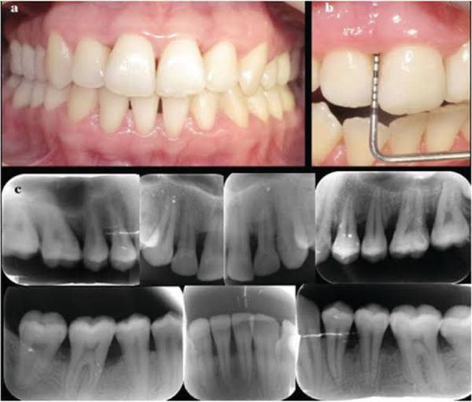 Aggressive periodontitis