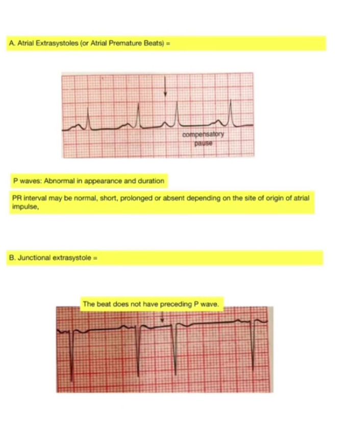 ECG Pathology