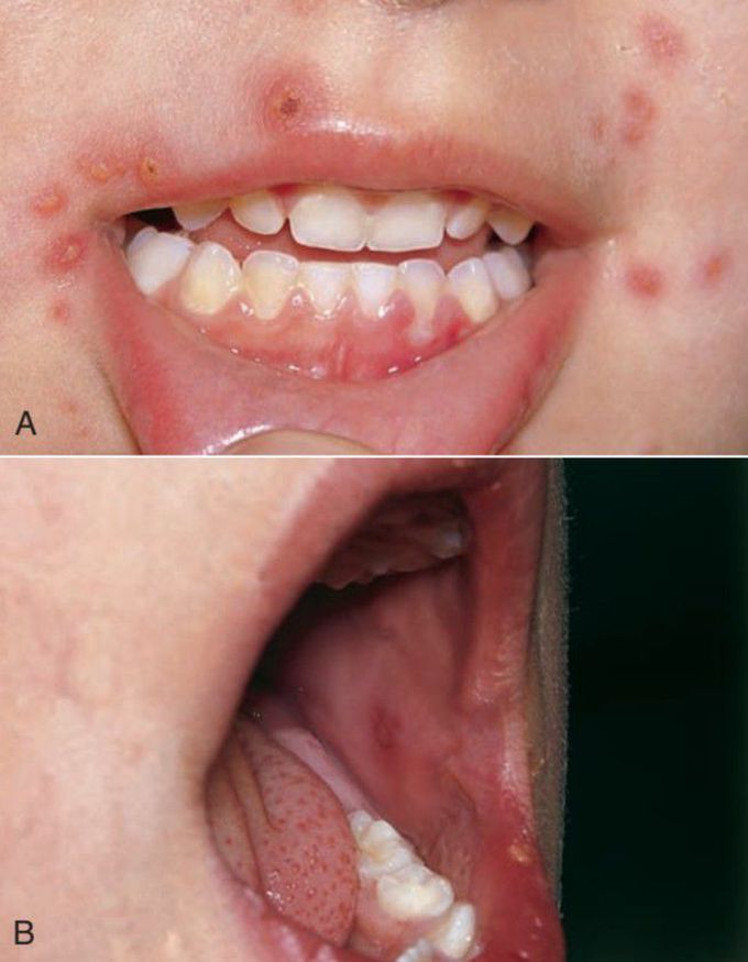 Varicella Perioral and Intraoral lesions
