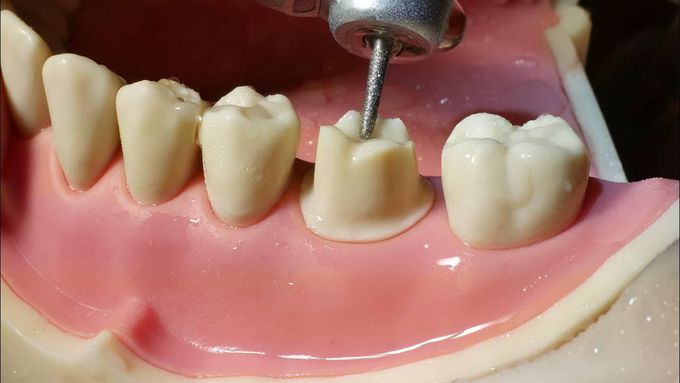 Molar Crown Preparation