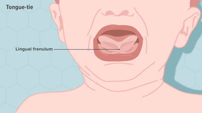 Symptoms of lingual frenulum