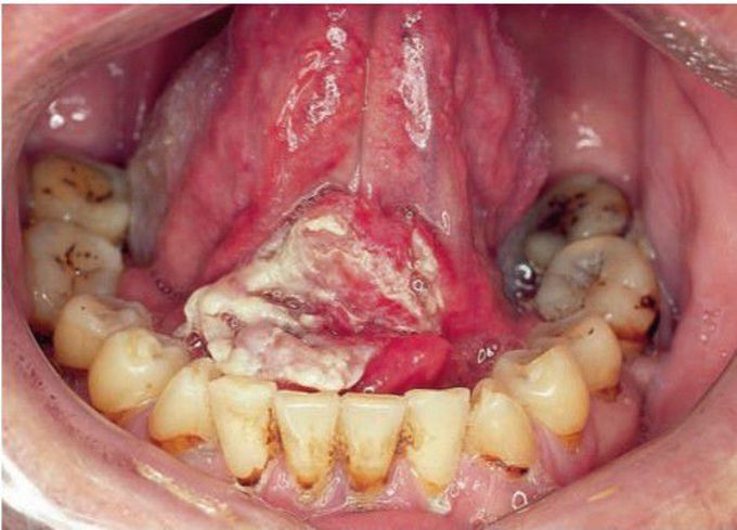 Squamous cell carcinoma of floor of mouth