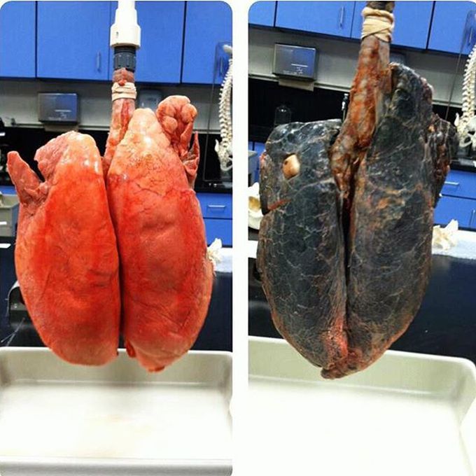 Comparing smokers' lungs to non-smokers' lungs!! 