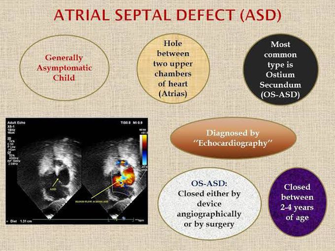 Atrial Septal Defect- Diagnosis