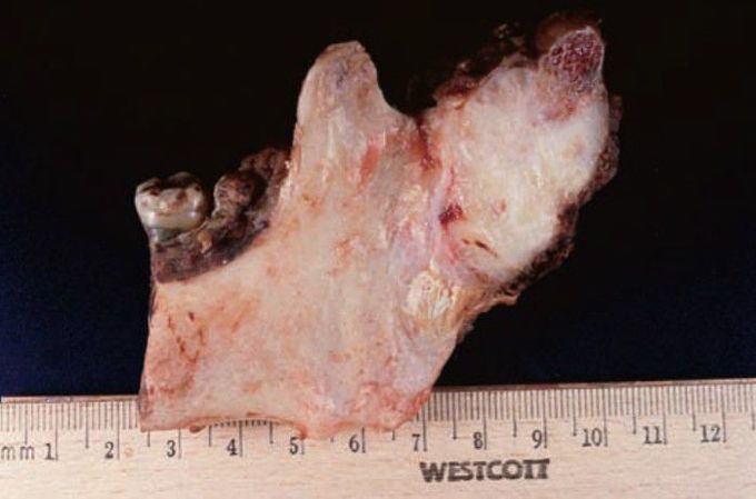 Parosteal osteosarcoma