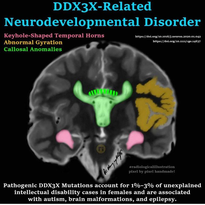 DDX3X Related Developmental Disorder