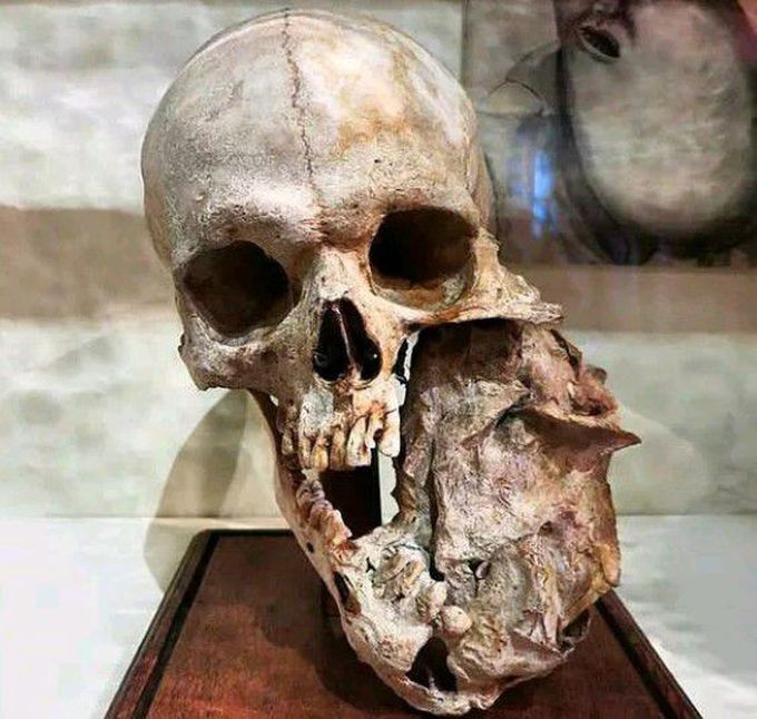 Mandibular tumor