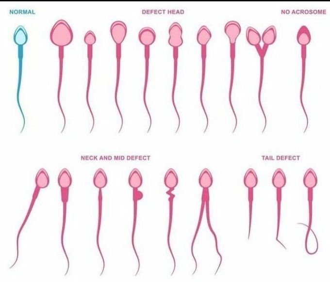 Sperm defects