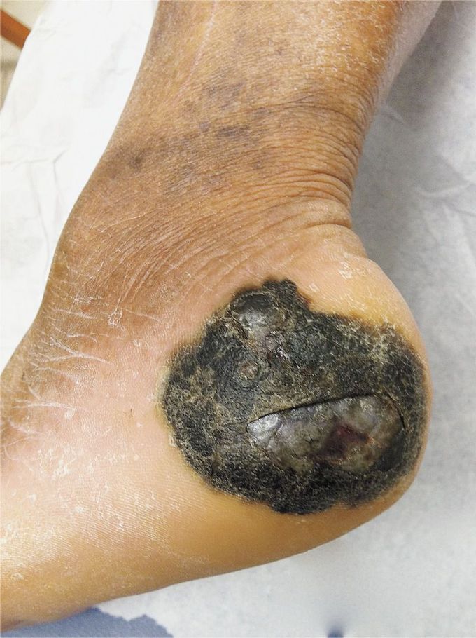 Acral Lentiginous Melanoma