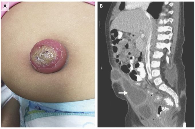 Infected Urachal Cyst