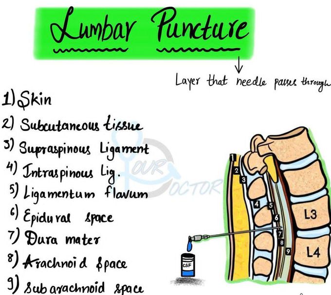 Lumber Puncture