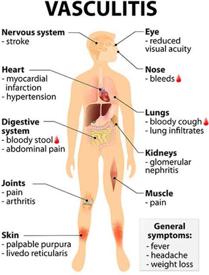 Systemic vasculitis