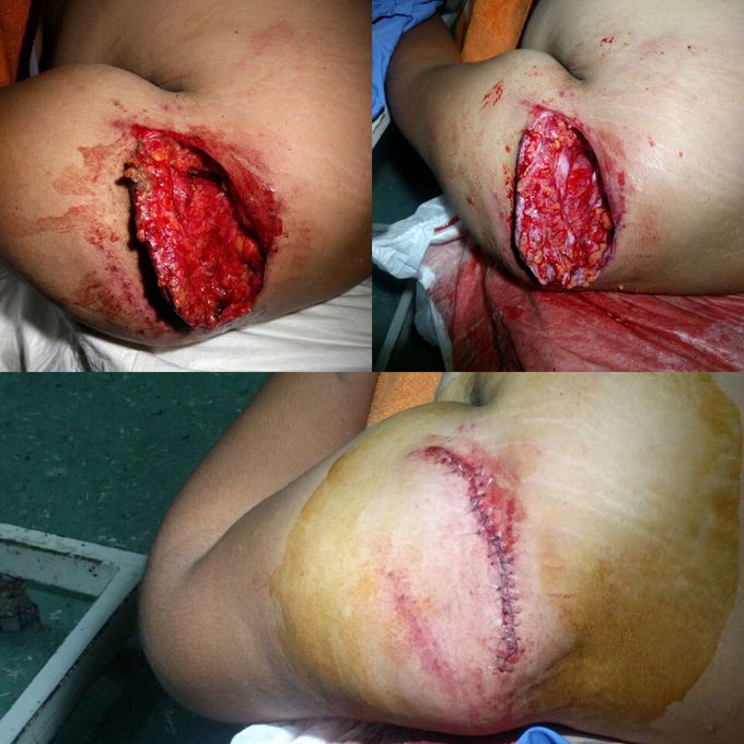 13 years old boy injured by tin, Left shoulder .