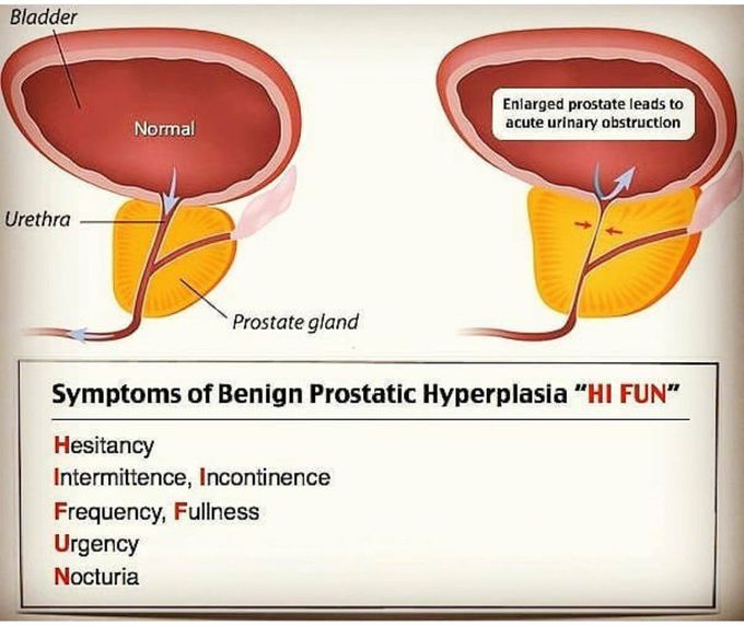 BPH mnemonic