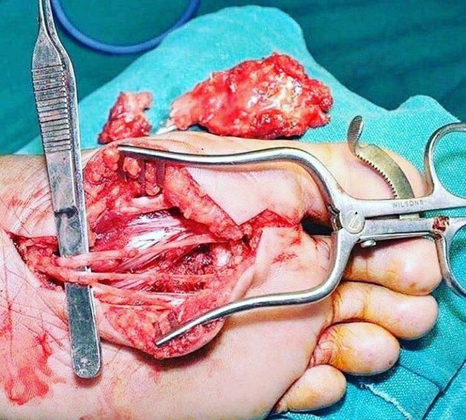 Excision of AV malformation of foot