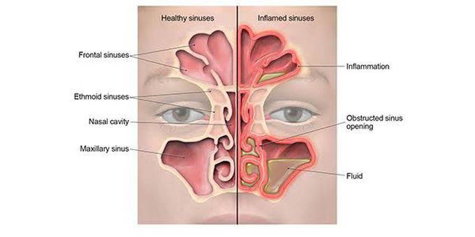 Sinusitis