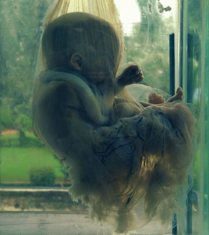 Foetus in Amniotic Sac!