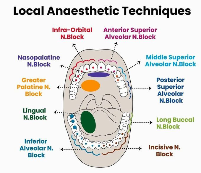 Local Anesthesia Techniques