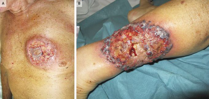 Pyoderma Gangrenosum in Ulcerative Colitis