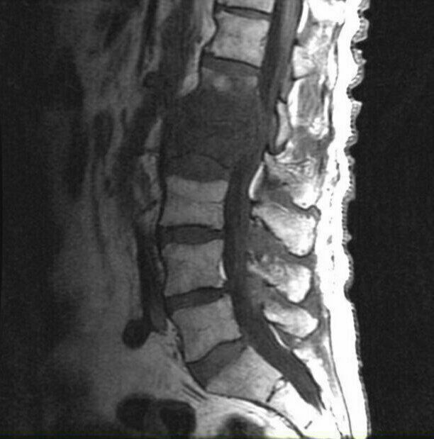 Lumbar spinal discitis - MEDizzy