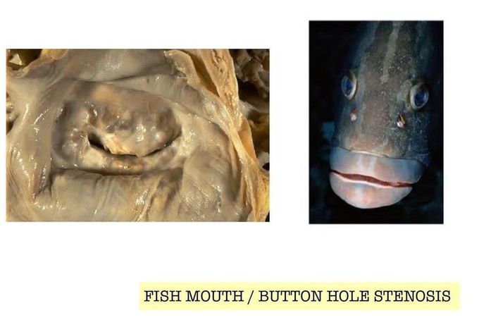 Fish Mouth Stenosis