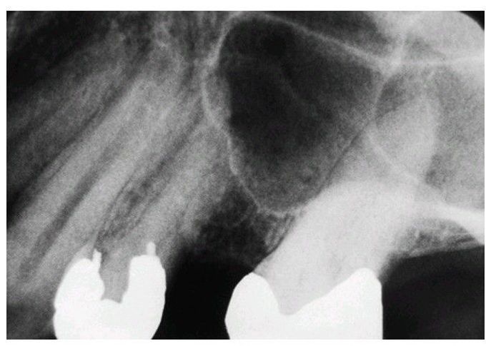 Approximity to maxillary sinus