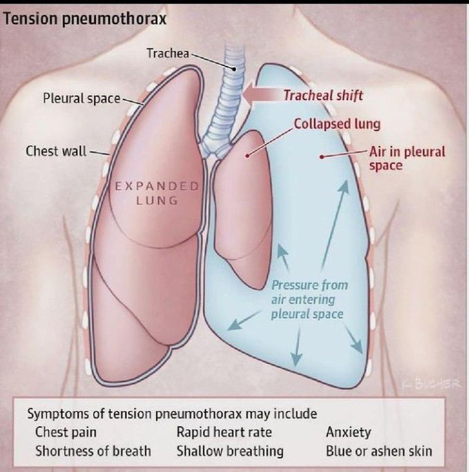 Tension pneumothorax