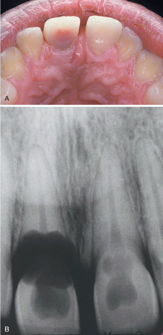 Internal resorption