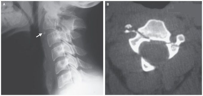 Traumatic Spondylolisthesis of the Axis