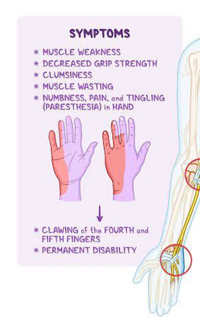 These are the symptoms of Nerve compression syndrome