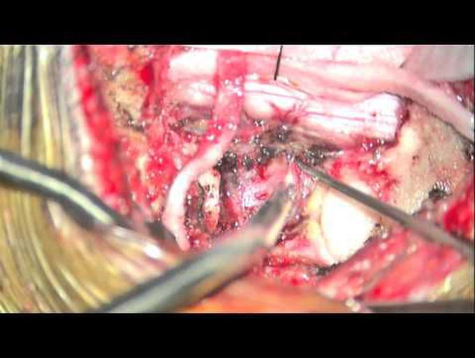 Resection of a cervical dumbbell schwannoma with stabilization