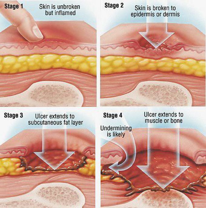 Stages of decubitus ulcer (bed or pressure sores) 