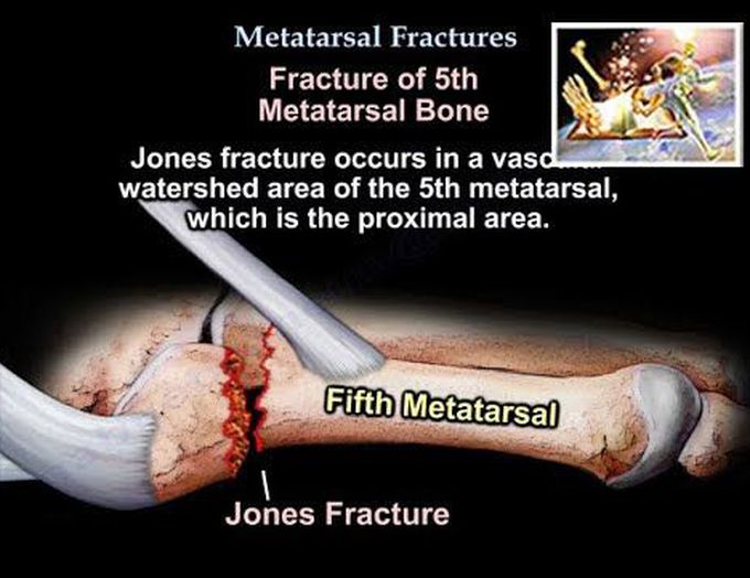 Metatarsal Fractures - Everything You Need To Know - Dr. Nabil Ebraheim
