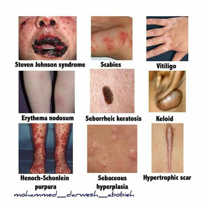Skin disease
