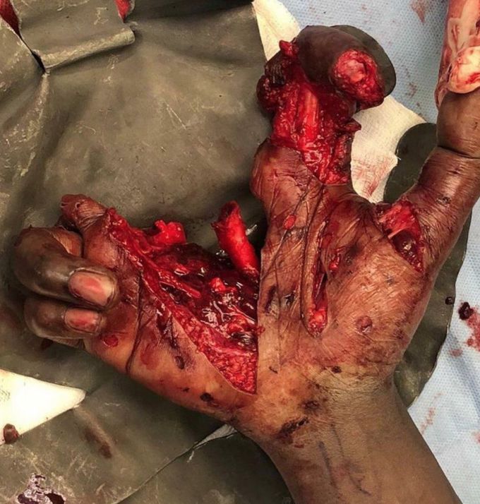 Man’s hand was split in two after a lit firework exploded before he could throw it at a party!!⁣