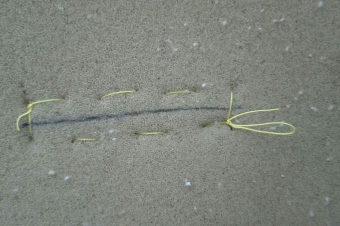 Suture