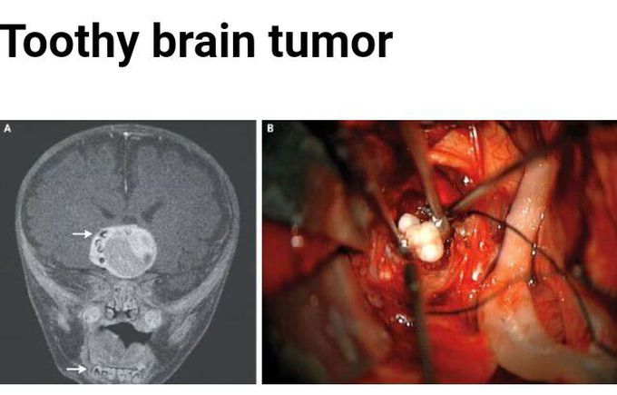 Toothy brain tumor