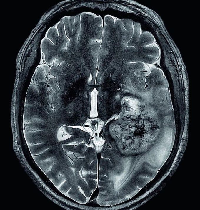 MR of a Brain Tumor 🧠
