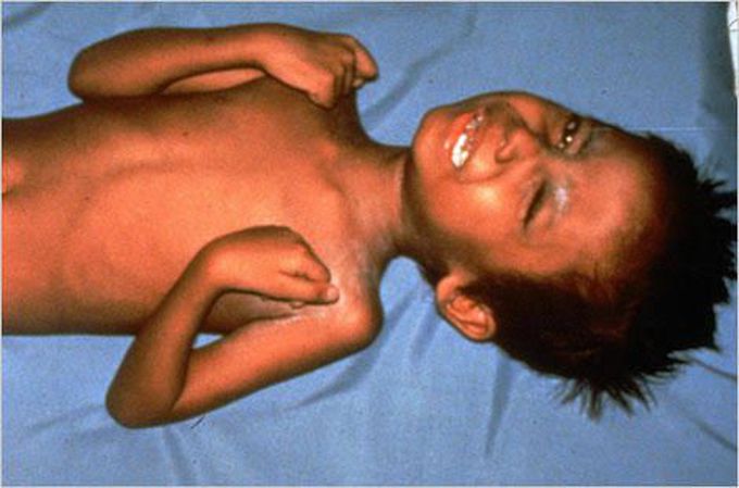 Flaccid paralysis