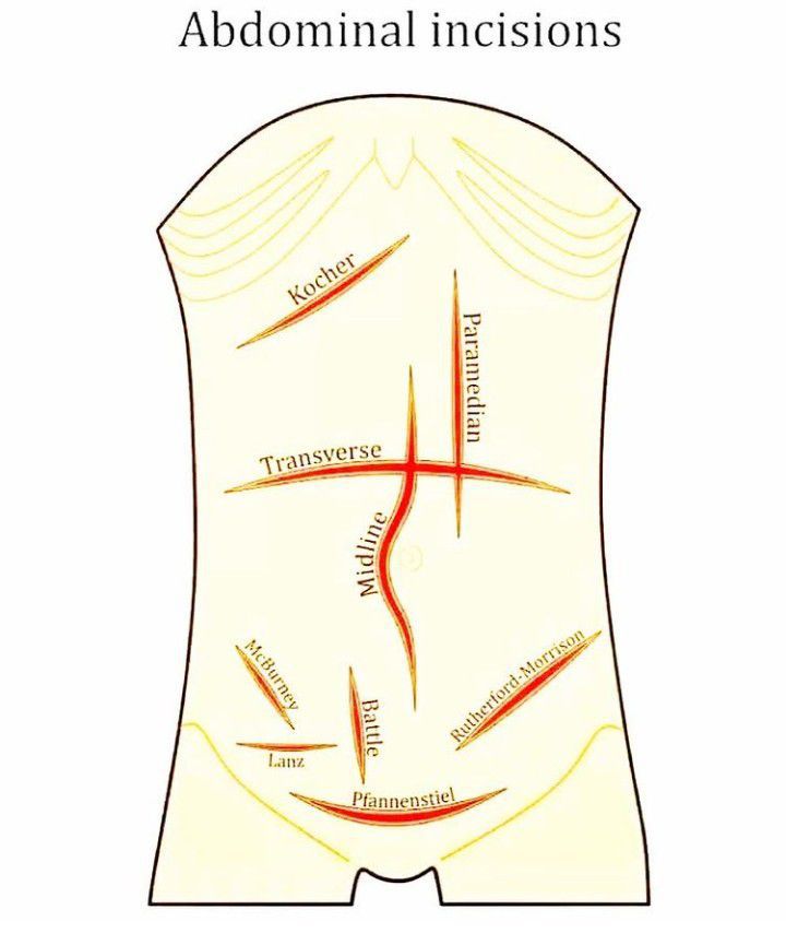 Abdominal Incisions - MEDizzy