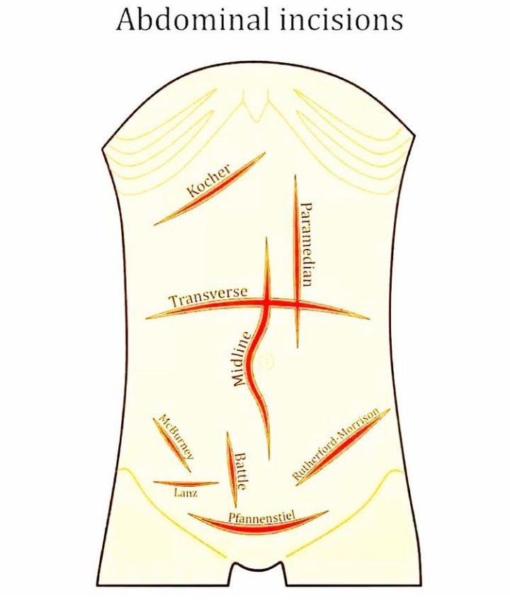 Abdominal Incisions Medizzy