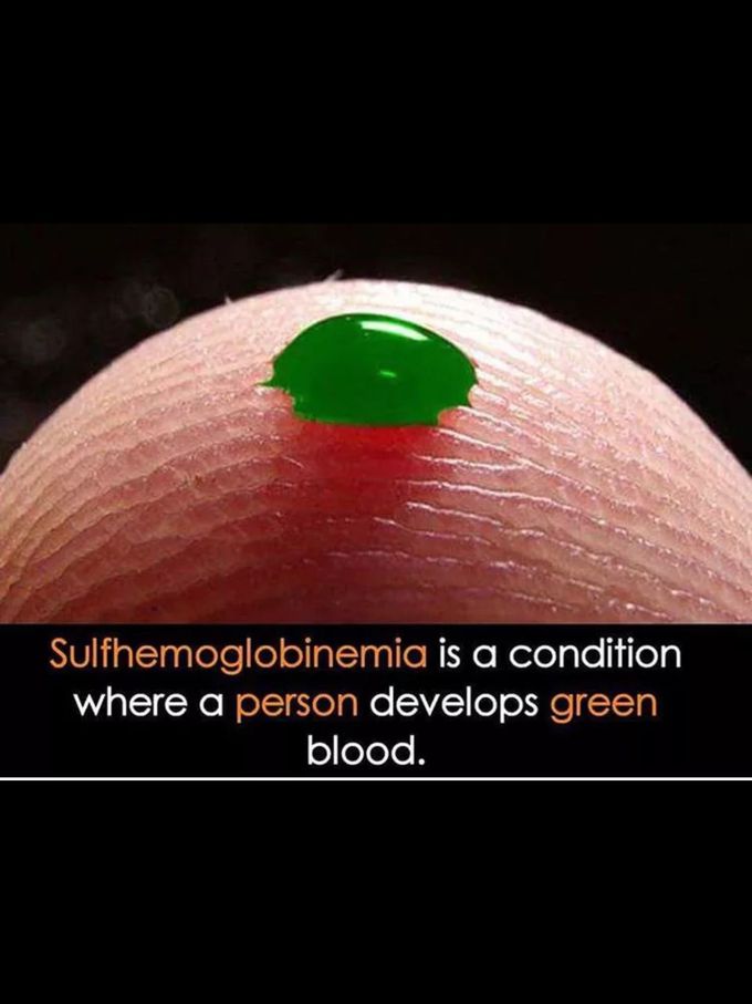 Sulfhemoglobinemia