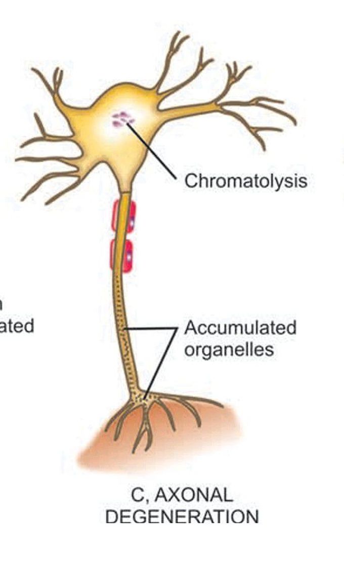 Pathologic reaction of peripheral nerve to injury (2)