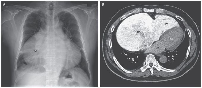 Enlarged Right Atrium