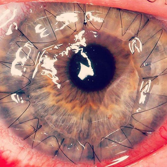 Corneal transplant