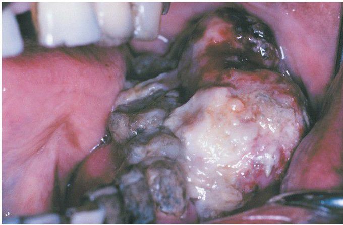 Neurofibromatosis Type I.