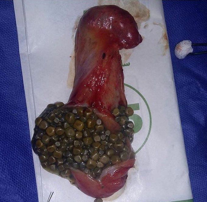 gallstones in poop