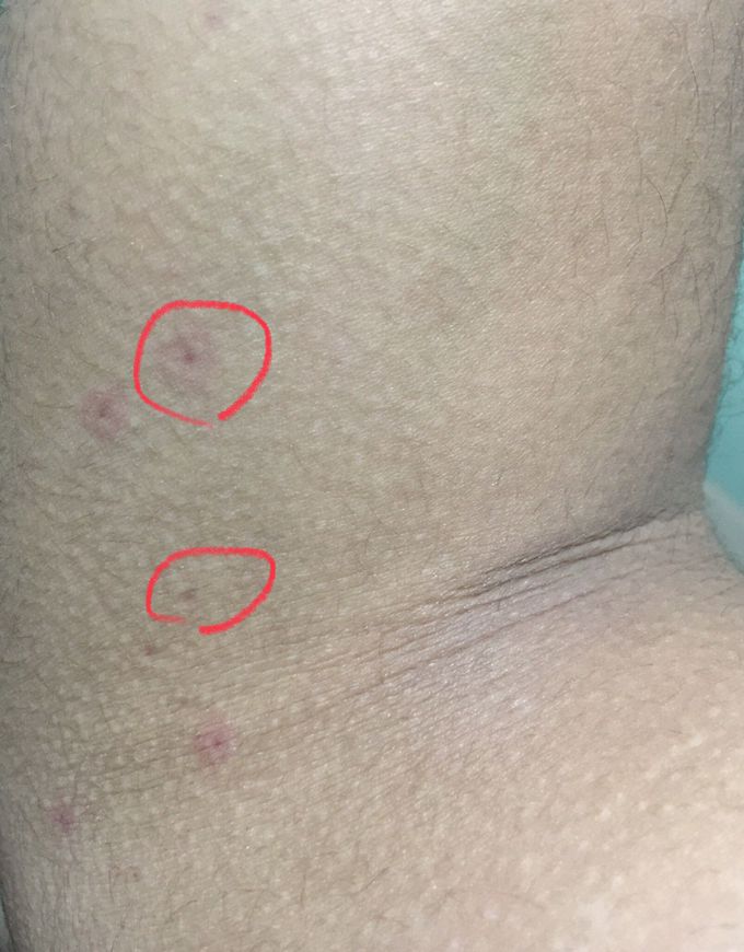 Allergy